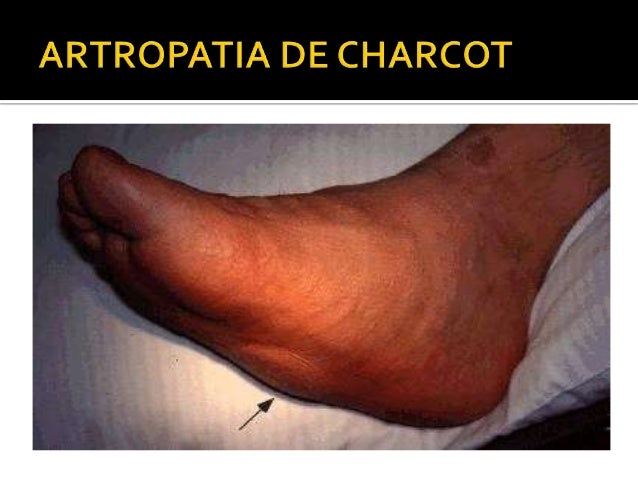Caso clinico. pie diabetico Caso clinico. pie diabetico