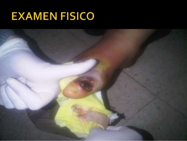 Caso clinico. pie diabetico Caso clinico. pie diabetico