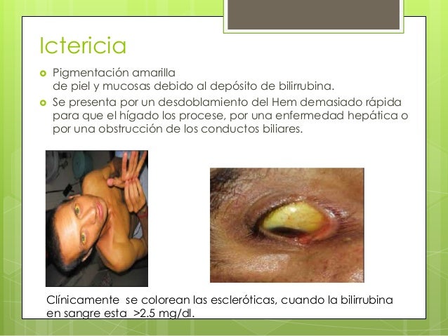 Síndrome Coledociano - Caso clinico