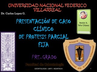 PRESENTACIÓN DE CASO
CLÍNICO
DE PROTESIS PARCIAL
FIJA
Facultad de Odontología
Dr. Carlos Lopez G.
PRE-GRADO
ODONTOLOGIA - UNFV - NEARTACH 1
 