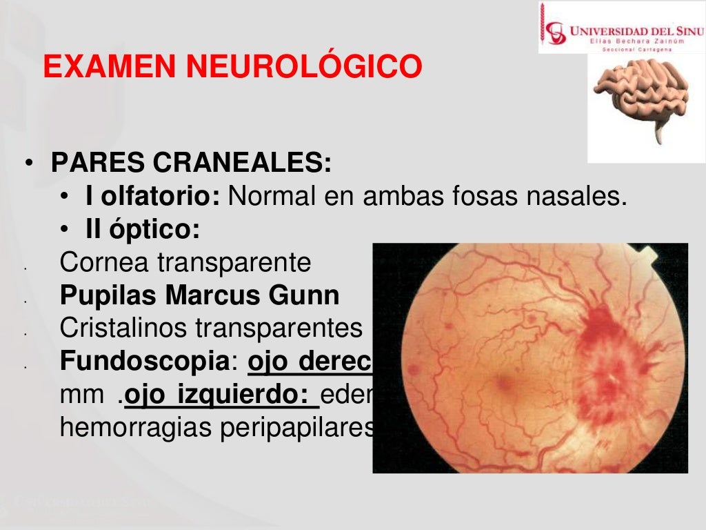 Caso clinico esclerosis multiple