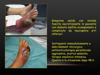 Gangrena umida con iniziale
fascite necrotizzante in paziente
con diabete mellito scompensato e
complicato da neuropatia arti
inferiori


Sottoposto immediatamente a
debridement chirurgico,
antibioticoterapia parenterale
aggressiva, scarico assoluto,
terapia insulinica intensiva.
Questa è la situazione dopo 48 h
 