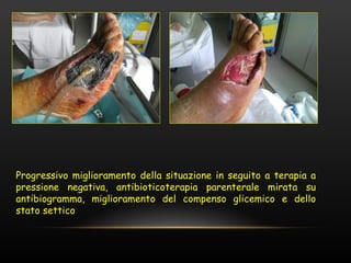 Progressivo miglioramento della situazione in seguito a terapia a
pressione negativa, antibioticoterapia parenterale mirata su
antibiogramma, miglioramento del compenso glicemico e dello
stato settico
 