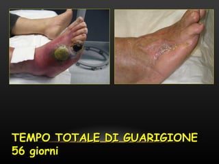 TEMPO TOTALE DI GUARIGIONE
56 giorni
 