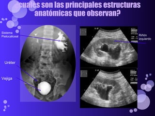 ¿cuales son las principales estructuras anatómicas que observan? Sistema Pielocaliceal Uréter Vejiga Riñón izquierdo 