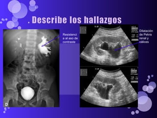 Dilatación de Pelvis renal y cálices Resistencia al aso de contraste 