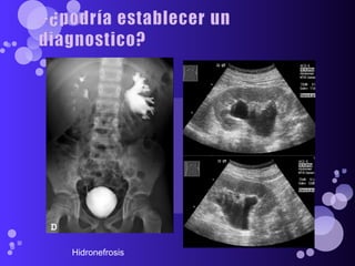 Hidronefrosis  