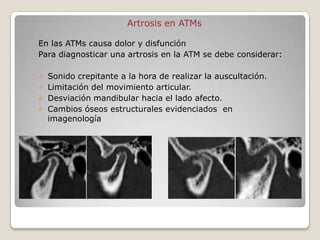 Artrosis en ATMs

En las ATMs causa dolor y disfunción
Para diagnosticar una artrosis en la ATM se debe considerar:

   Sonido crepitante a la hora de realizar la auscultación.
   Limitación del movimiento articular.
   Desviación mandibular hacia el lado afecto.
   Cambios óseos estructurales evidenciados en
    imagenología
 