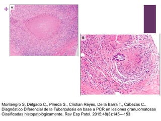 +
Montengro S, Delgado C., Pineda S., Cristian Reyes, De la Barra T., Cabezas C..
Diagnóstico Diferencial de la Tuberculosis en base a PCR en lesiones granulomatosas
Clasificadas histopatológicamente. Rev Esp Patol. 2015;48(3):145---153
 