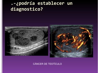 CÁNCER DE TESTÍCULO 