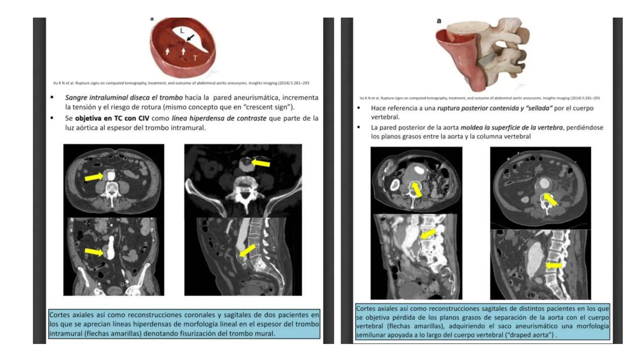 caso clinico ANEURISMA DE LA AORTA ABDOMINAL.pptx