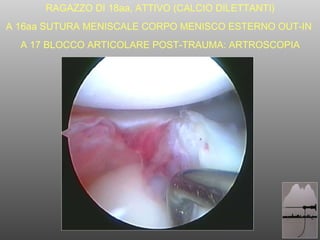 RAGAZZO DI 18aa, ATTIVO (CALCIO DILETTANTI) A 16aa SUTURA MENISCALE CORPO MENISCO ESTERNO OUT-IN  A 17 BLOCCO ARTICOLARE POST-TRAUMA: ARTROSCOPIA 