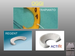 OGGI REGENT ACTI fit TRAPIANTO 