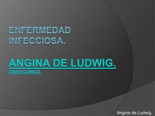 Angina de Ludwig.
 