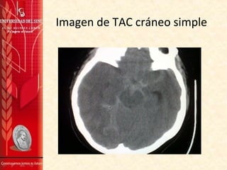 Imagen de TAC cráneo simple
 