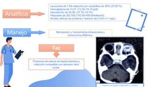 Analítica
Leucocitos de 7.84 miles/ml) con neutrófilos de 36% (37-80 %)
Hemoglobina de 12.07, (12.20-18-10 g/dl)
Hematocrito de 36.98, (37.70- 53.70)
Plaquetas de 282 000 (142.00-450-00miles/ml)
Niveles séricos de proteína c reactiva de 0.243 (<1 mg/L)
Manejo Meropenem y Vancomicina intravenosos y
tobramicina oftálmica.
Tac
Presencia de edema de tejidos blandos y
colección compatible con absceso retro
ocular.
Presencia de absceso subperióstico y orbitario
 