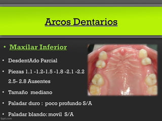 Arcos Dentarios

• Maxilar Inferior
• DesdentAdo Parcial

• Piezas 1.1 -1.2-1.5 -1.8 -2.1 -2.2
  2.5- 2.8 Ausentes

• Tamaño mediano

• Paladar duro : poco profundo S/A

• Paladar blando: movil S/A
 
