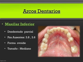 Arcos Dentarios

• Maxilar Inferior
 • Desdentado parcial

 • Pza Ausentes: 3.8 , 3.6

 • Forma ovoide

 • Tamaño : Mediano
 