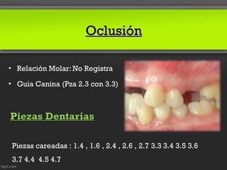 Oclusión

• Relación Molar: No Registra

• Guia Canina (Pza 2.3 con 3.3)



Piezas Dentarias

 Piezas careadas : 1.4 , 1.6 , 2.4 , 2.6 , 2.7 3.3 3.4 3.5 3.6
 3.7 4.4 4.5 4.7
 