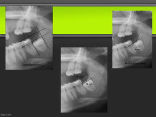 9 mm




Clase II posición C                   Profundidad osea




                      13 mm


                              15 mm
 