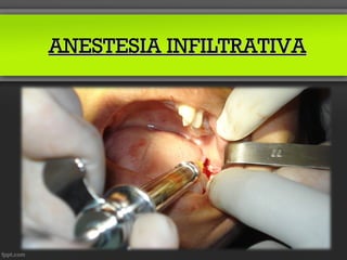 ANESTESIA INFILTRATIVA
 
