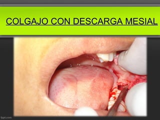 COLGAJO CON DESCARGA MESIAL
 