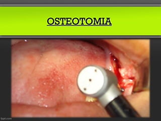OSTEOTOMIA
 