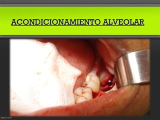 ACONDICIONAMIENTO ALVEOLAR
 
