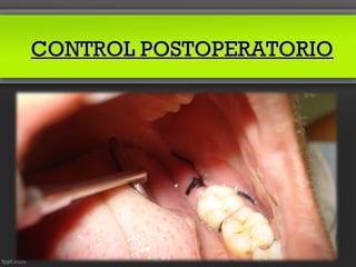 CONTROL POSTOPERATORIO
 