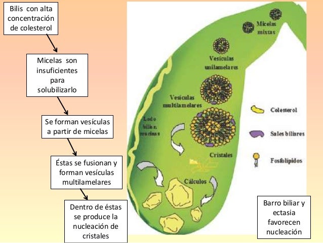 Diagnóstico de coledocolitiasis en RM Diagnóstico de coledocolitiasis en RM