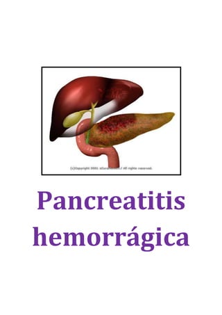 Pancreatitis
hemorrágica
 
