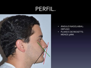 Caso clinico de ortodoncia | PPTX