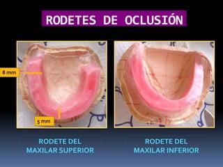 CASO CLÍNICO DE PROTESIS TOTAL | PPTX