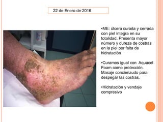 22 de Enero de 2016
•ME: úlcera curada y cerrada
con piel integra en su
totalidad. Presenta mayor
número y dureza de costras
en la piel por falta de
hidratación
•Curamos igual con Aquacel
Foam como protección.
Masaje concienzudo para
despegar las costras.
•Hidratación y vendaje
compresivo
 