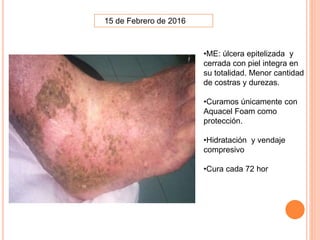 15 de Febrero de 2016
•ME: úlcera epitelizada y
cerrada con piel integra en
su totalidad. Menor cantidad
de costras y durezas.
•Curamos únicamente con
Aquacel Foam como
protección.
•Hidratación y vendaje
compresivo
•Cura cada 72 hor
 