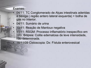 Exames: 04/11: TC Conglomerado de Alças intestinais aderidas à bexiga ( região antero lateral esquerda) + bolha de gás no interior. 04/11: Sumário de urina 10/11: Reação de Mantoux negativa 11/11: RSGM: Processo inflamatório inespecífico em reto. Biópsia: Colite edematosa de leve intensidade, não determinada. 16/11/09 Cistoscopia: Dx: Fístula enterovesical 