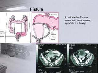 Fístula A maioria das fístulas formam-se entre o cólon sigmóide e a bexiga Crohn 