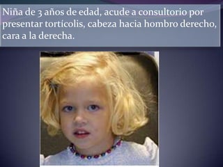 Niña de 3 años de edad, acude a consultorio por
presentar tortícolis, cabeza hacia hombro derecho,
cara a la derecha.

 