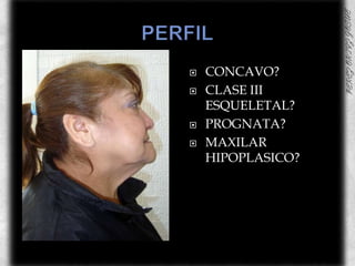 PERFILCONCAVO?CLASE III ESQUELETAL?PROGNATA?MAXILAR HIPOPLASICO?