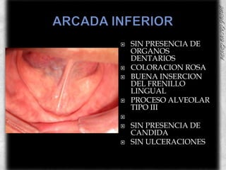 ARCADA INFERIORSIN PRESENCIA DE ORGANOS DENTARIOSCOLORACION ROSABUENA INSERCION DEL FRENILLO LINGUAL PROCESO ALVEOLAR TIPO IIISIN PRESENCIA DE CANDIDASIN ULCERACIONES