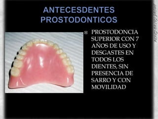 ANTECESDENTES PROSTODONTICOSPROSTODONCIA SUPERIOR CON 7 AÑOS DE USO Y DESGASTES EN TODOS LOS DIENTES, SIN PRESENCIA DE SARRO Y CON MOVILIDAD