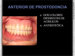 ANTERIOR DE PROSTODONCIADOS COLORES DIFERENTES DE ACRILICOSANTIESTETICA