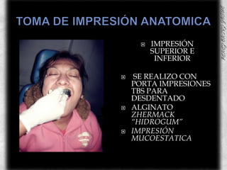TOMA DE IMPRESIÓN ANATOMICAIMPRESIÓN SUPERIOR E INFERIOR SE REALIZO CON PORTA IMPRESIONES  TBSPARA  DESDENTADOALGINATO ZHERMACK “HIDROGUM”IMPRESIÓN MUCOESTATICA