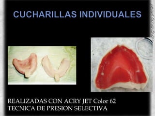 CUCHARILLAS INDIVIDUALESREALIZADAS CON ACRY JET Color 62TECNICA DE PRESION SELECTIVA