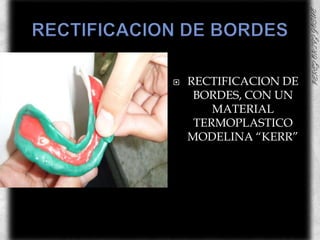 RECTIFICACION DE BORDESRECTIFICACION DE BORDES, CON UN MATERIAL TERMOPLASTICO  MODELINA “KERR”