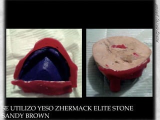 SE UTILIZO YESO ZHERMACK ELITE STONE SANDY BROWN