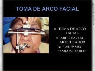 TOMA DE ARCO FACIALTOMA DE ARCO FACIALARCO FACIAL ARTICULADOR “WHIP MIX SEMIAJUSTABLE”