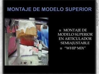 MONTAJE DE MODELO SUPERIORMONTAJE DE MODELO SUPERIOR EN ARTICULADOR  SEMIAJUSTABLE “WHIP MIX”
