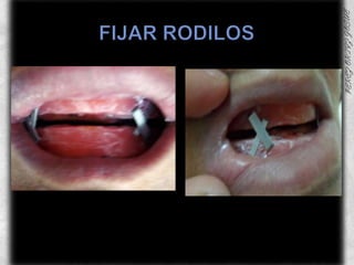 FIJAR RODILOS