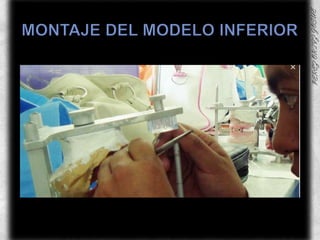 MONTAJE DEL MODELO INFERIOR